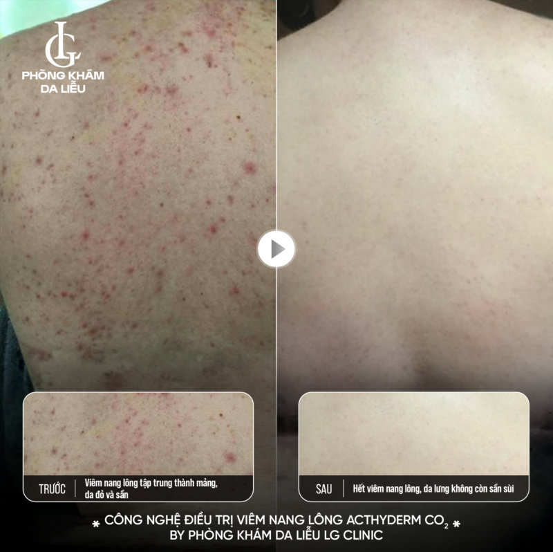 Nam giới bị viêm nang lông, mụn lưng dai dẳng: Khám phá phác đồ Acthyderm CO2 đánh bay mụn viêm, thâm sần sau 1 liệu trình 5 Nam giới bị viêm nang lông, mụn lưng dai dẳng: Khám phá phác đồ Acthyderm CO2 đánh bay mụn viêm, thâm sần sau 1 liệu trình 5