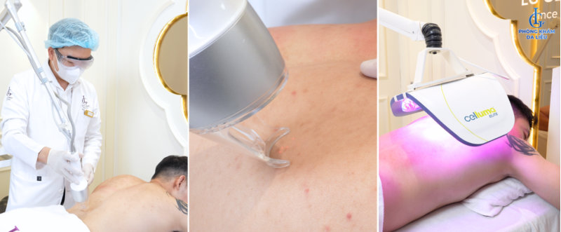 Nam giới bị viêm nang lông, mụn lưng dai dẳng: Khám phá phác đồ Acthyderm CO2 đánh bay mụn viêm, thâm sần sau 1 liệu trình 4 Nam giới bị viêm nang lông, mụn lưng dai dẳng: Khám phá phác đồ Acthyderm CO2 đánh bay mụn viêm, thâm sần sau 1 liệu trình 4